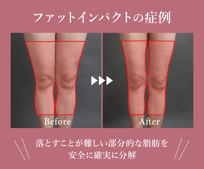 ファットインパクトの症例
